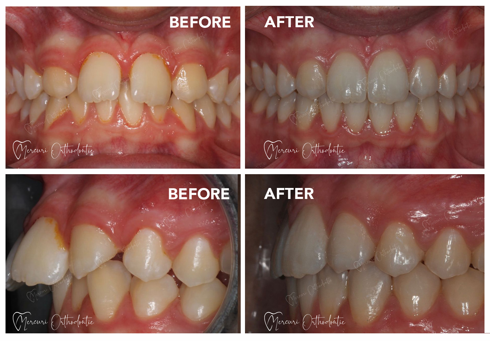 Missing teeth (dental agenesia)
