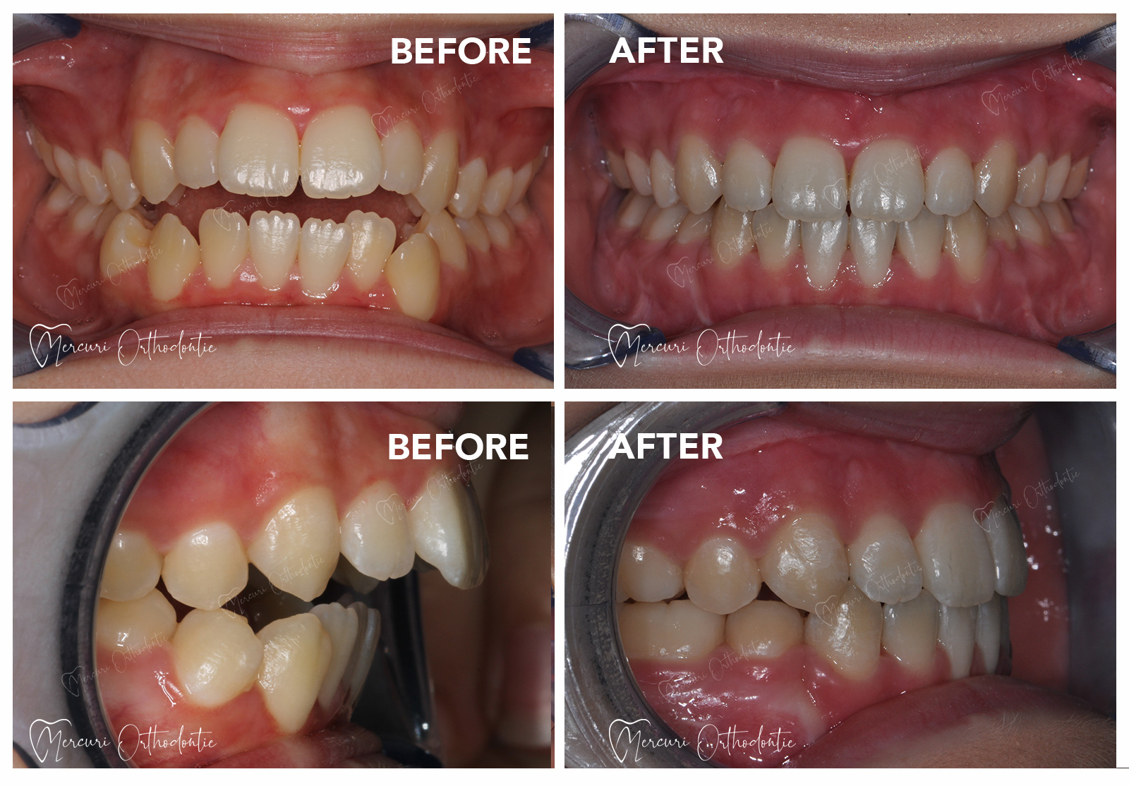 Trattamento Denti sporgenti Lousanne - Mercuri Orthodontie