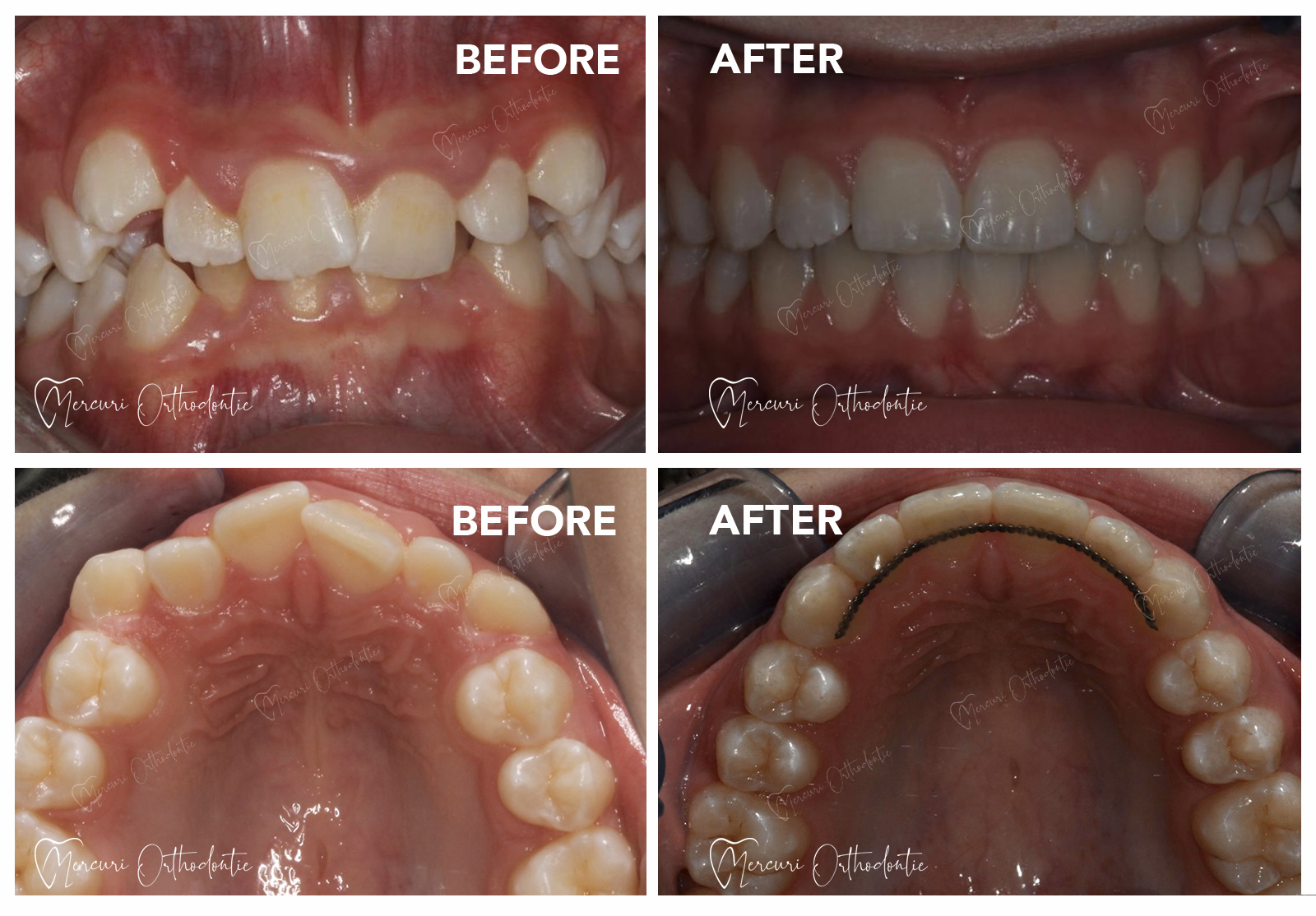 Affolamento Dentale soluzioni