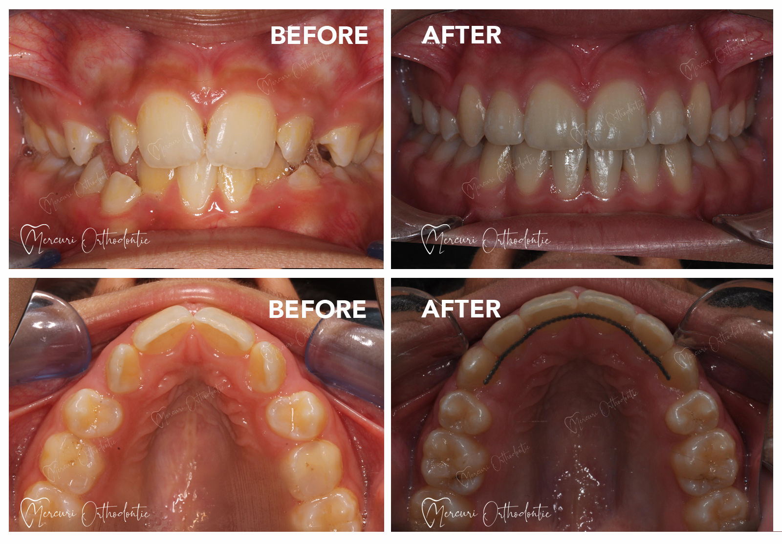 Le bilan première étape du traitement orthodontique.