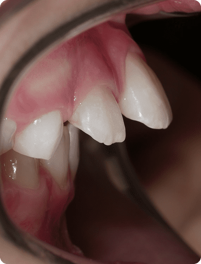 Dents en avant Traitement Écublens