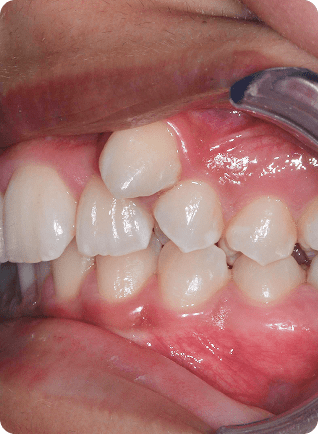 Encombrement dentaire Écublens Orthodontie